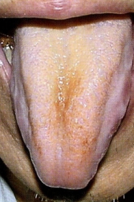 痩薄舌