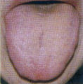 淡紅舌
