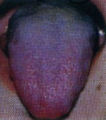 紫色の舌
