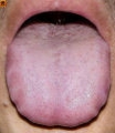 胖大舌(Swelling Tongue)