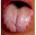 歯痕舌(Teeth Printed Tongue)