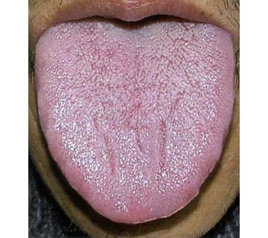 舌 に 亀裂