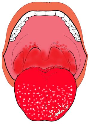 舌診の事例2