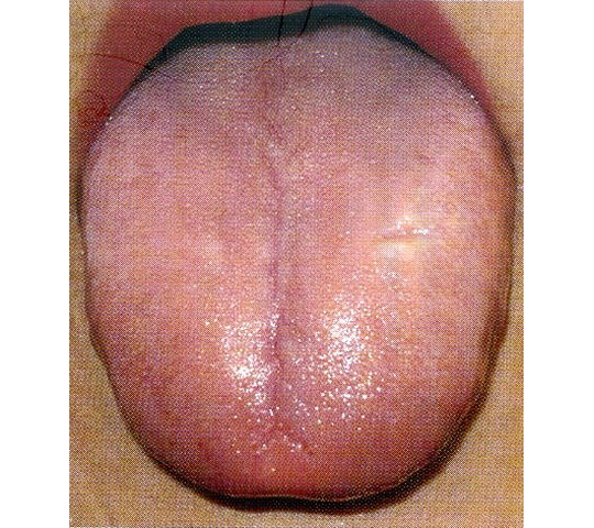 舌 に 紫 の 斑点