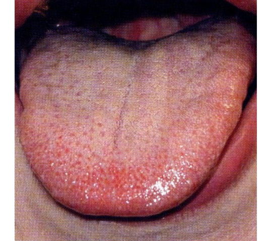 赤い ぶつぶつ 舌 舌の先に赤い斑点があります。