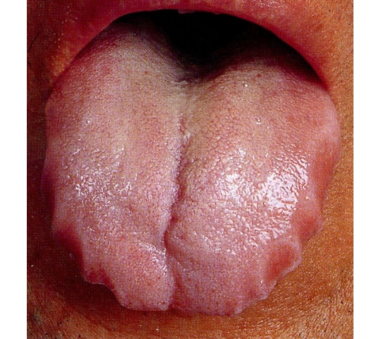 歯痕舌 しこんぜつ Teeth Printed Tongue 舌を診察すれば 病気がわかる 舌診