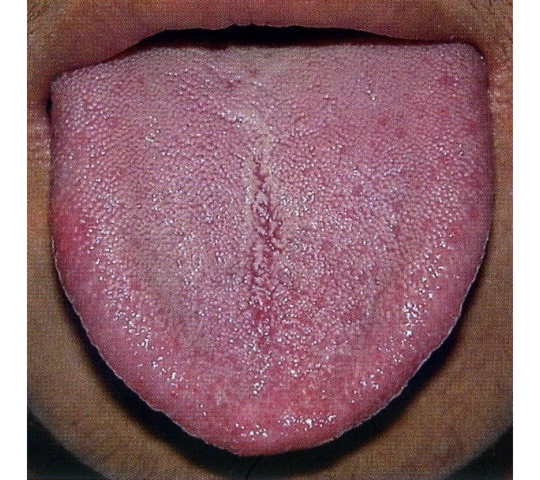 舌苔少